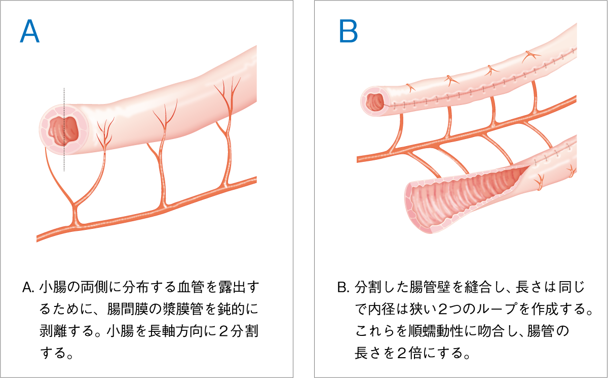 図6 Bianchi手術