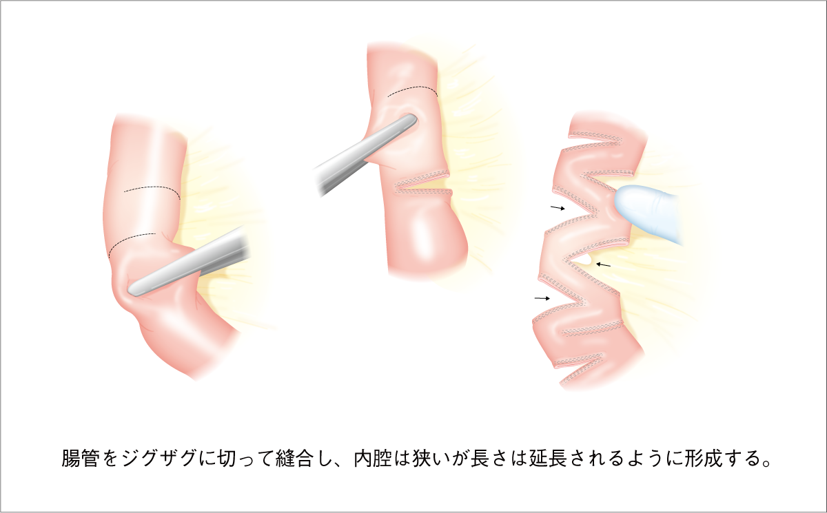 図7 STEP手術